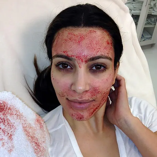 Close-up image of a microneedling facial treatment being performed to rejuvenate the skin.