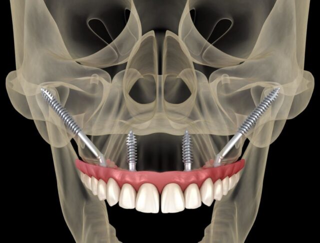 An illustration showing zygomatic dental implants anchored in the zygoma bone, offering a solution for individuals with severe bone loss in the upper jaw.